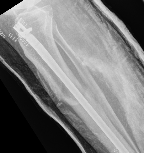 Proximal Tibial Malunion